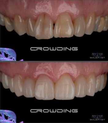 Smile Makeovers