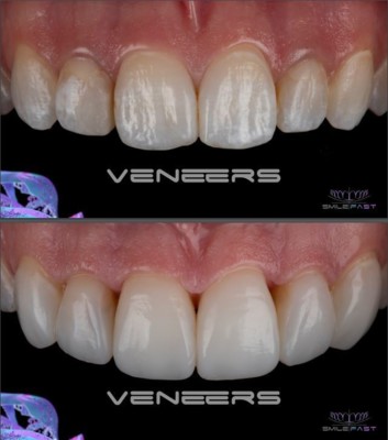 Smile Makeovers