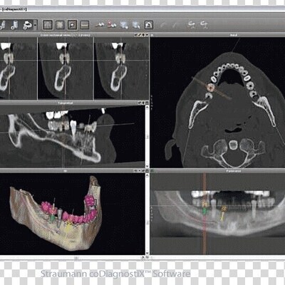 Dental Implants