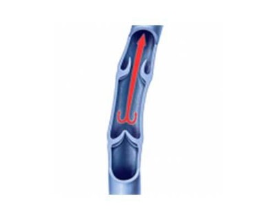 Varicocele Embolization (VE) - Operation Image 1