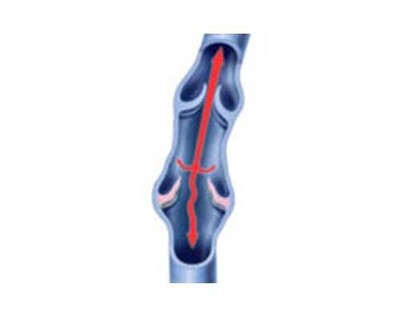 Varicocele Embolization (VE) - Operation Image 2