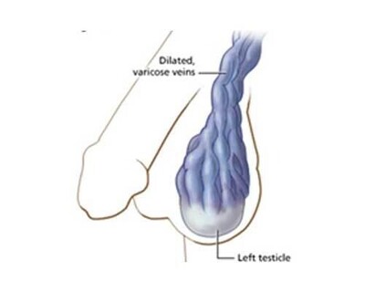Varicocele Embolization (VE) - Operation Image 3
