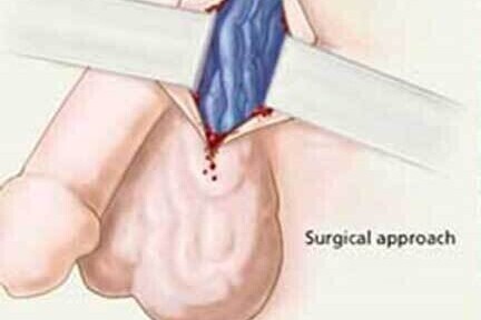 Varicocele Embolization (VE) - Operation Image 6