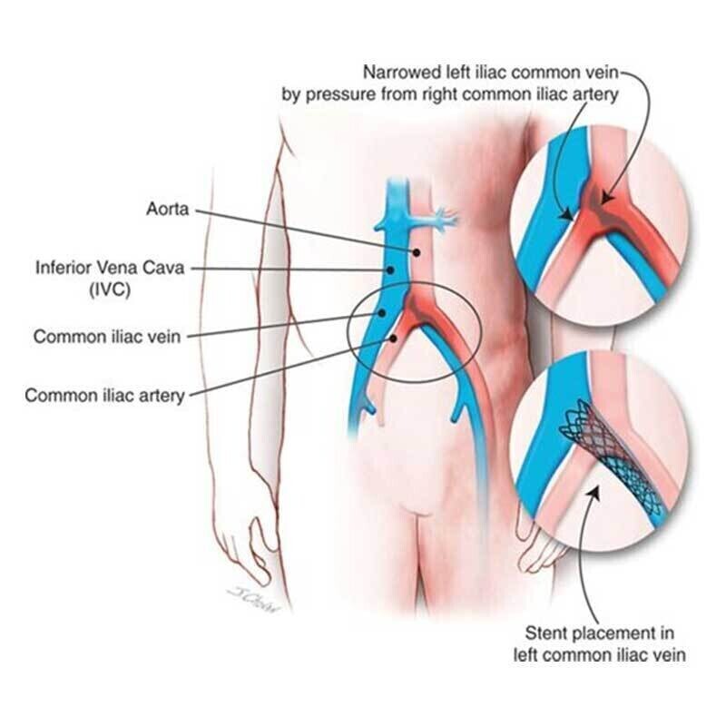 Deep Venous Disease -Image 1