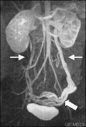 Pelvic Congestion Syndrome - Image 3
