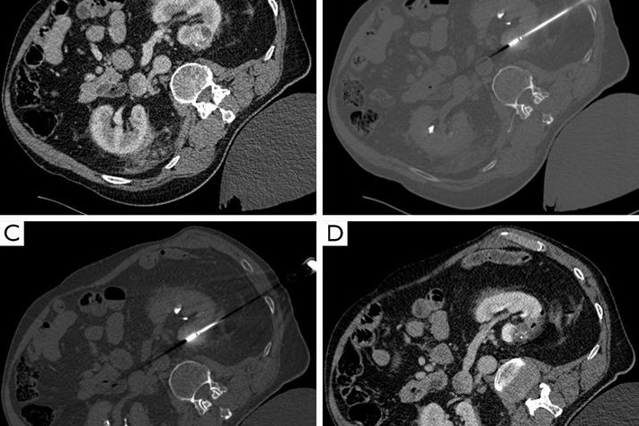 Percutaneous Kidney Tumour Ablation - Image 2