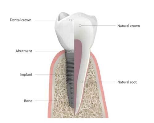 Implants