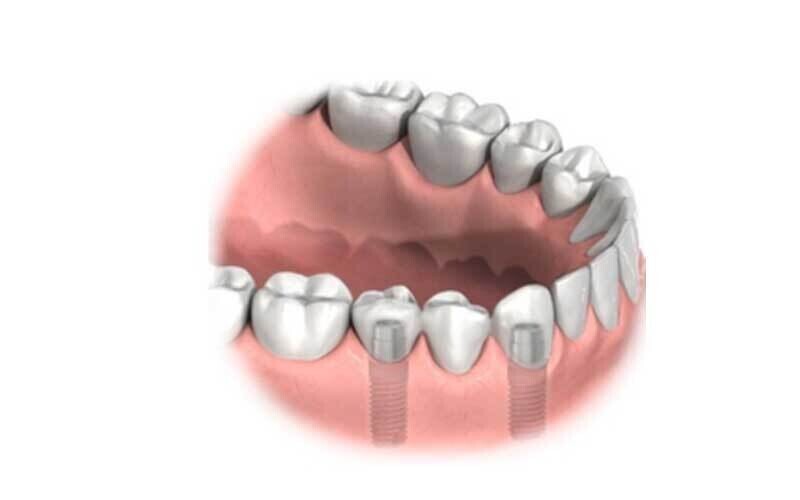 Treatment Options