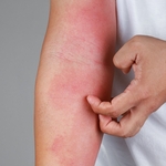 Eczema and the Skin Microbiome