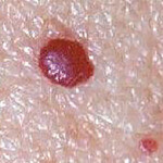 CRYOPEN | Mole, Cyst, Wart and Skin Tag Removal