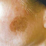 CRYOPEN | Mole, Cyst, Wart and Skin Tag Removal