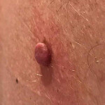 CRYOPEN | Mole, Cyst, Wart and Skin Tag Removal