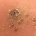 CRYOPEN | Mole, Cyst, Wart and Skin Tag Removal