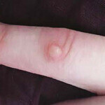 CRYOPEN | Mole, Cyst, Wart and Skin Tag Removal