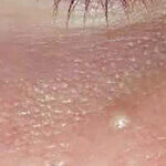 CRYOPEN | Mole, Cyst, Wart and Skin Tag Removal