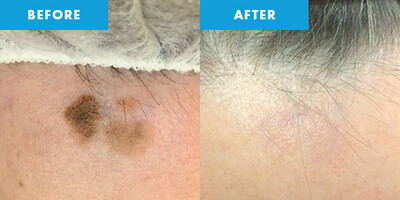 CRYOPEN | Mole, Cyst, Wart and Skin Tag Removal