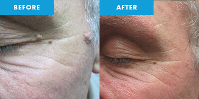 CRYOPEN | Mole, Cyst, Wart and Skin Tag Removal