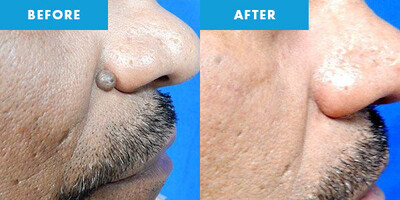 CRYOPEN | Mole, Cyst, Wart and Skin Tag Removal