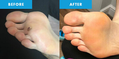CRYOPEN | Mole, Cyst, Wart and Skin Tag Removal