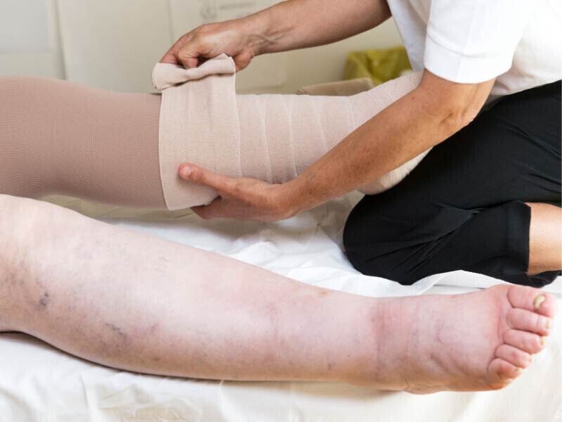 Lymphoedema