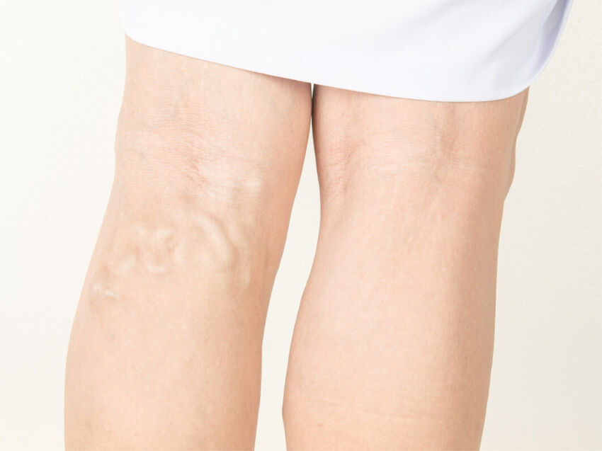 Varicose veins