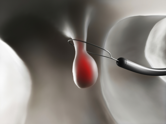 Flexible Sigmoidoscopy