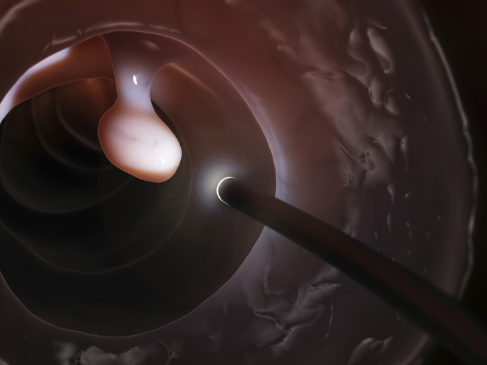 Colonoscopy