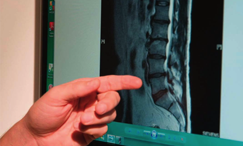 Back Pain