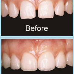 Emergency Dentist N11, Composite Tooth Bonding N11, Teeth Whitening N11