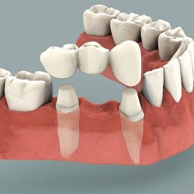Emergency Dentist N11, Composite Tooth Bonding N11, Teeth Whitening N11