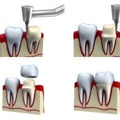 Emergency Dentist N11, Composite Tooth Bonding N11, Teeth Whitening N11
