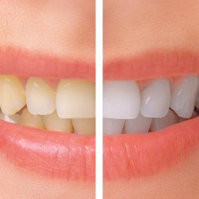 Emergency Dentist N11, Composite Tooth Bonding N11, Teeth Whitening N11
