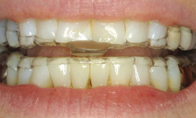 Emergency Dentist N11, Composite Tooth Bonding N11, Teeth Whitening N11