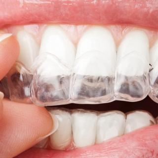 Emergency Dentist N11, Composite Tooth Bonding N11, Teeth Whitening N11