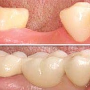 Emergency Dentist N11, Composite Tooth Bonding N11, Teeth Whitening N11