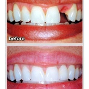 Emergency Dentist N11, Composite Tooth Bonding N11, Teeth Whitening N11