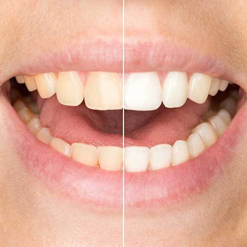 Tooth Whitening Church Street Dental Practice