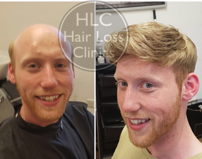 Hair Replacement HLC Hair Loss Treatment Clinics