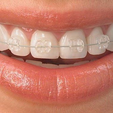FREE ORTHODONTIC & IMPLANT CONSULTATION - SAVE £100