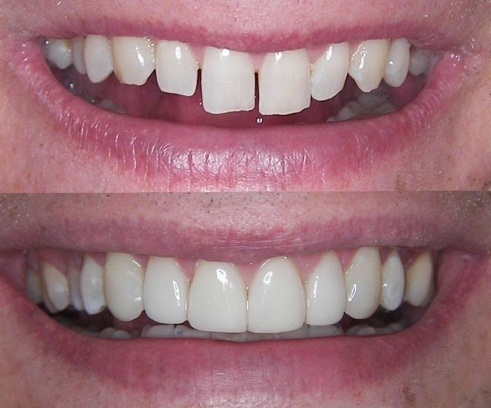 Composite Bonding North London White Fillings & Dental Bonding