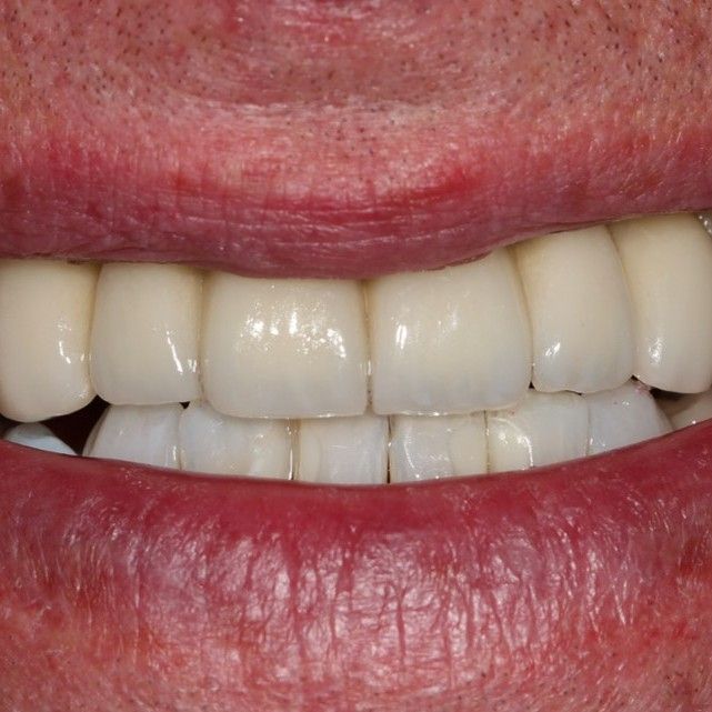 Dental implant case study image
