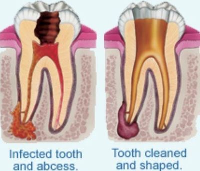 Emergency Dentist N11, Composite Tooth Bonding N11, Teeth Whitening N11