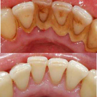 Teeth Stain Removal in North London