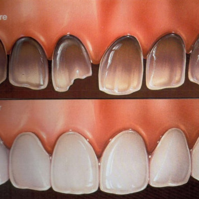 Emergency Dentist N11, Composite Tooth Bonding N11, Teeth Whitening N11