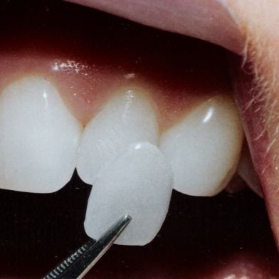 Emergency Dentist N11, Composite Tooth Bonding N11, Teeth Whitening N11