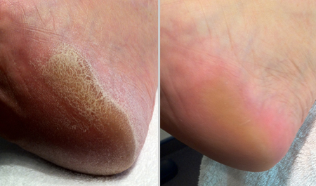 *NEW to Heavenly Green, Introducing Callus Peel by Mavex*