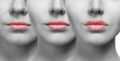 Botox Birmingham, Lip fillers Birmingham, Anti-wrinkle treatment Birmingham