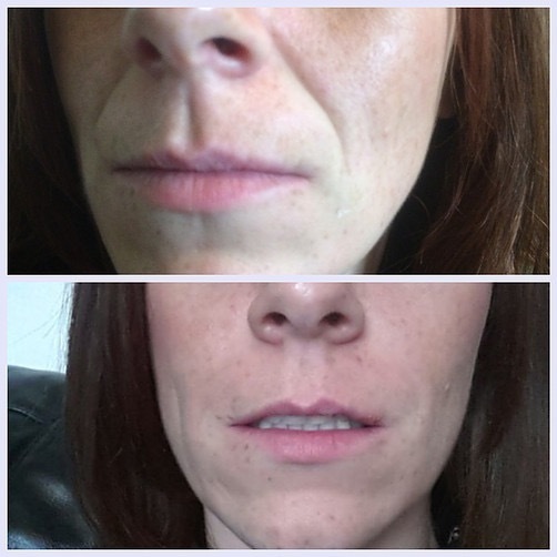Nose to Mouth Lines Botox Fillers Sheffield £70