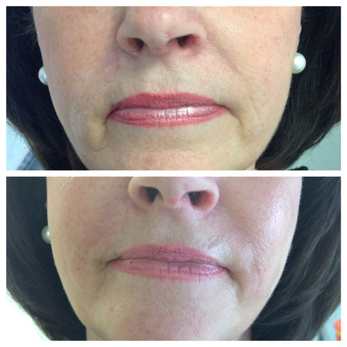 Nose to Mouth Lines Botox Fillers Sheffield £70