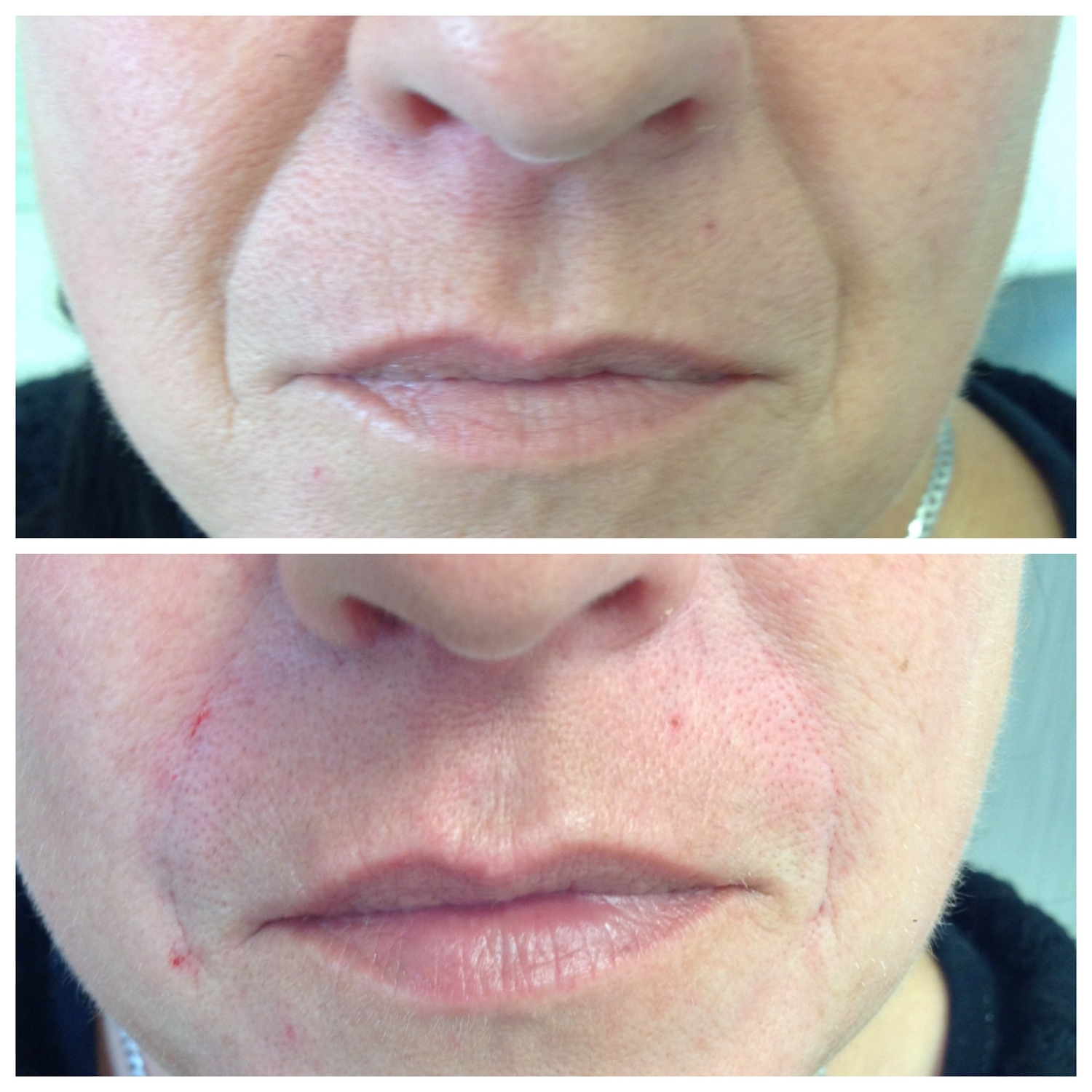 Nose to Mouth Lines Botox Fillers Sheffield £70